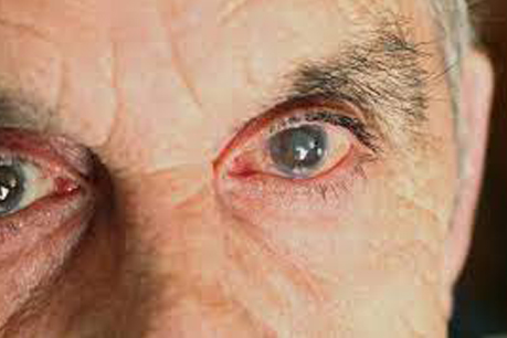 #PraCegoVer: Foto mostra os olhos de uma pessoa idosa com uma mancha característica da catarata.